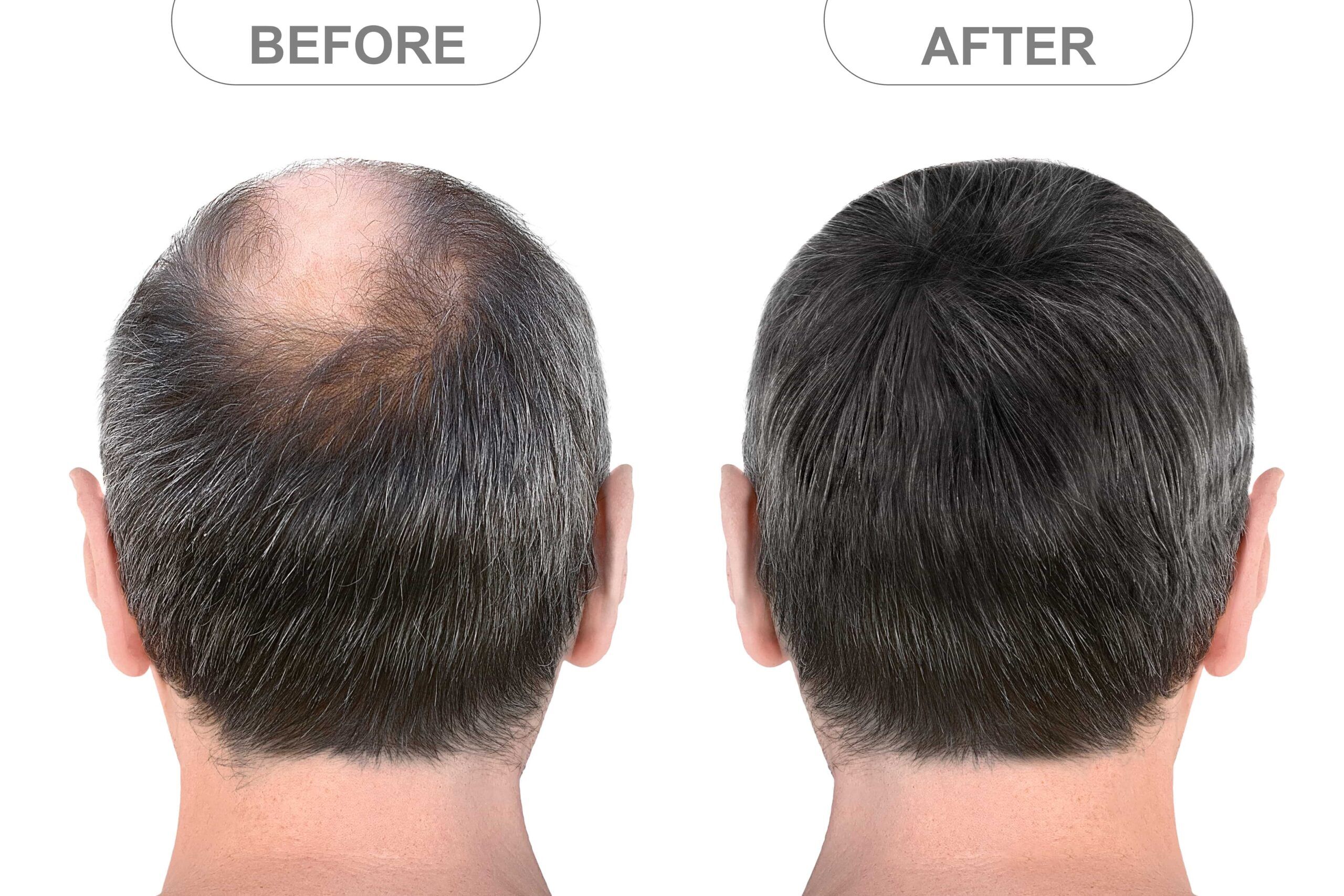 Keravive Scalp Treatment: Benefits for Hair Growth Explained